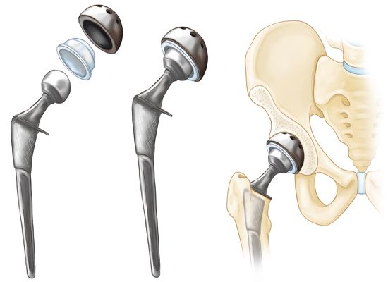 Hip Replacement Surgeon in Padmanabhanagar