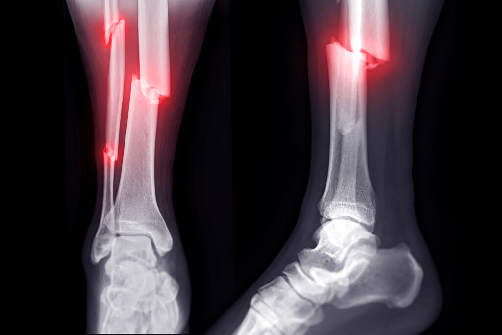 Fracture Treatment in Banashankari