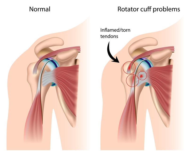 Rotator Cuff Tear Treatment in Padmanabhanagar