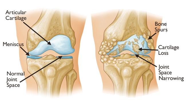 Arthritis Treatment in JP Nagar