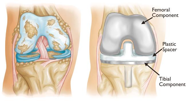 Knee Replacement Surgeon in Kumaraswamy Layout