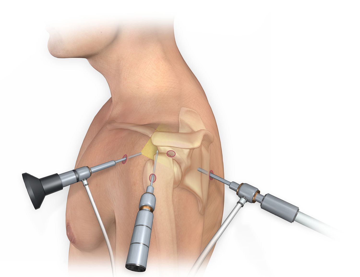 Shoulder arthroscopic surgeon Shoulder Arthroscopic Surgeon in JP Nagar